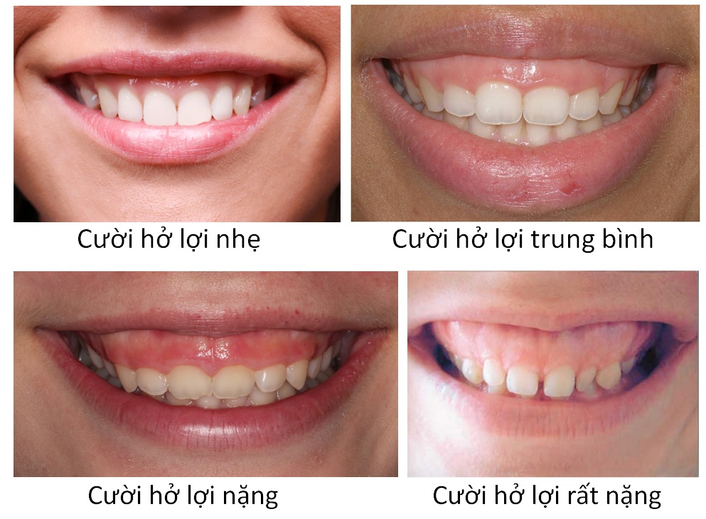 Các kiểu cười hở lợi