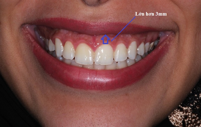Cười hở lợi khi khoảng cách cổ răng và vành môi trên lớn hơn 3mm