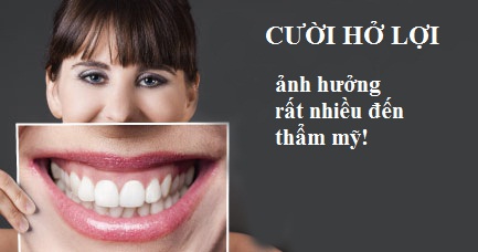 Cười hở lợi gây ảnh hưởng rất nhiều đến thẩm mỹ
