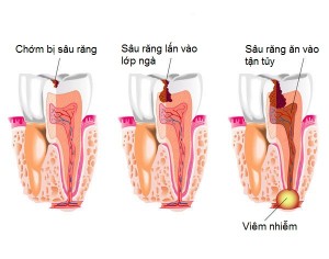 Quy trình minh họa bệnh sâu răng