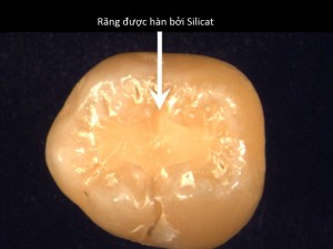 Răng được hàn bởi Siliccat