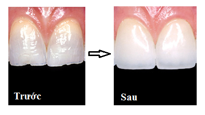 Hàn răng cửa bằng vật liệu Composite