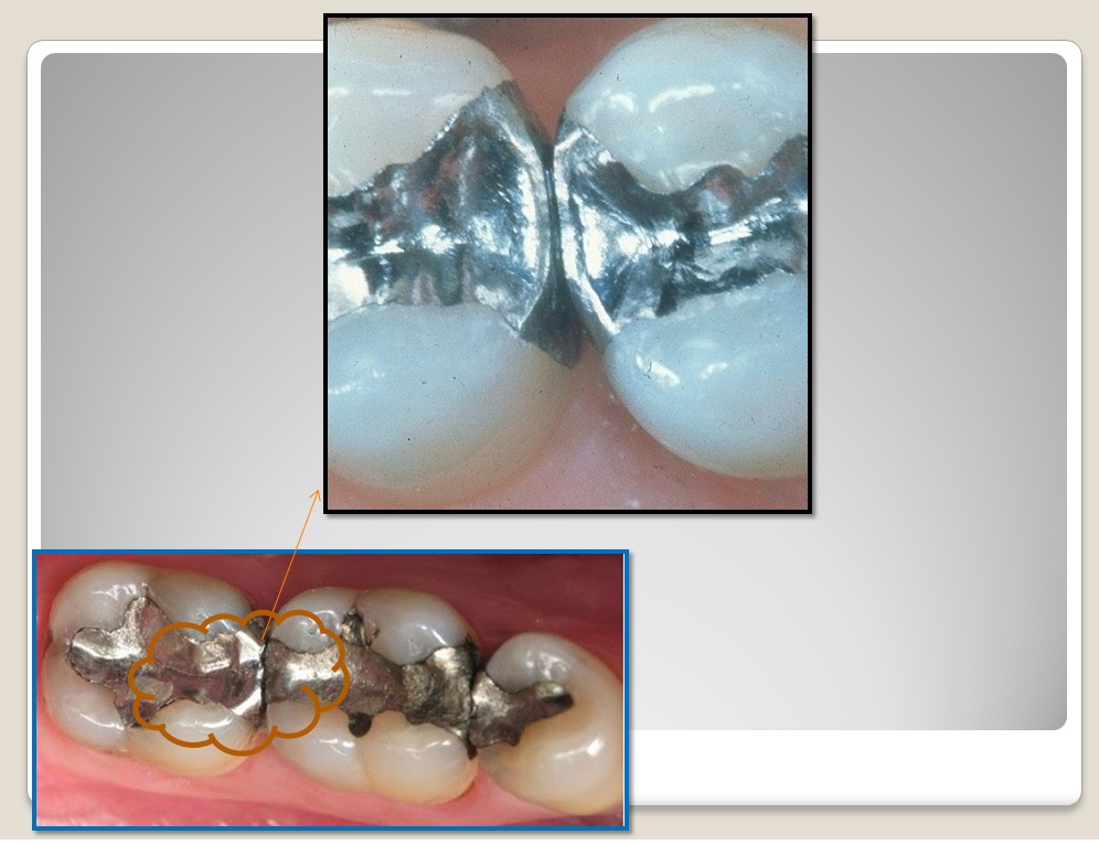 Vật liệu hàn răng Amalgam