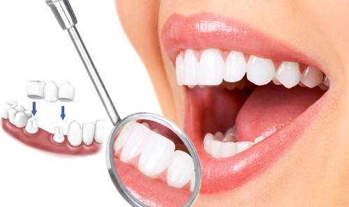 Bọc răng sứ ở Thái Bình