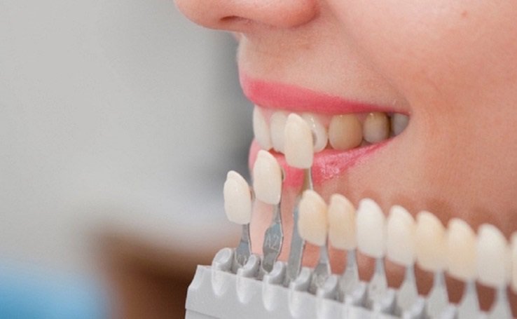 Bọc răng sứ ở Thái Bình