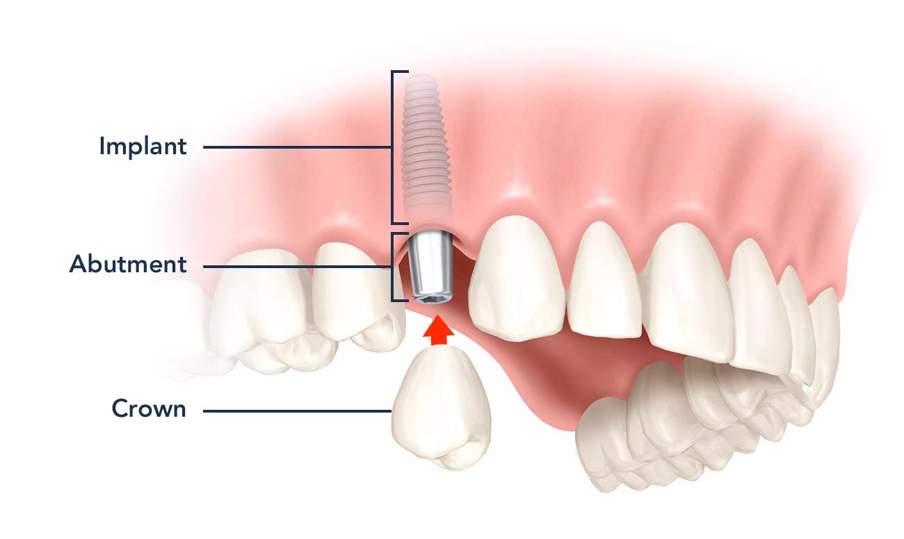 Ngay khi nhổ răng chính là thời điểm tốt nhất dùng phương pháp implant thành phố Thái Bình