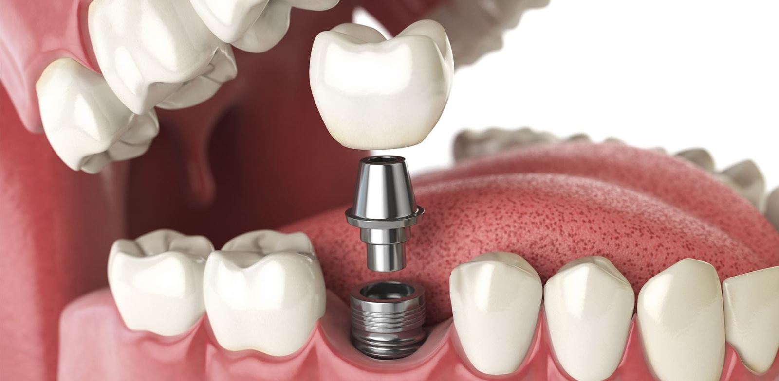 Trồng răng Implant thành phố Thái Bình là một phương pháp hiện đại 