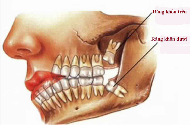 Nhổ răng khôn giá rẻ ở Thái Bình