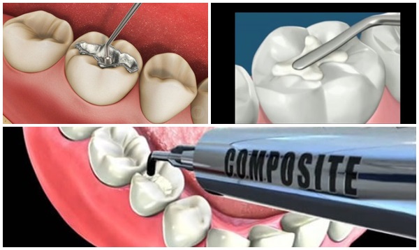 Trám răng thẩm mỹ ở Thái Bình