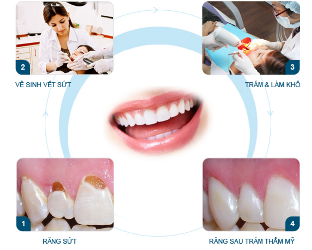 Trám răng thẩm mỹ ở Thái Bình
