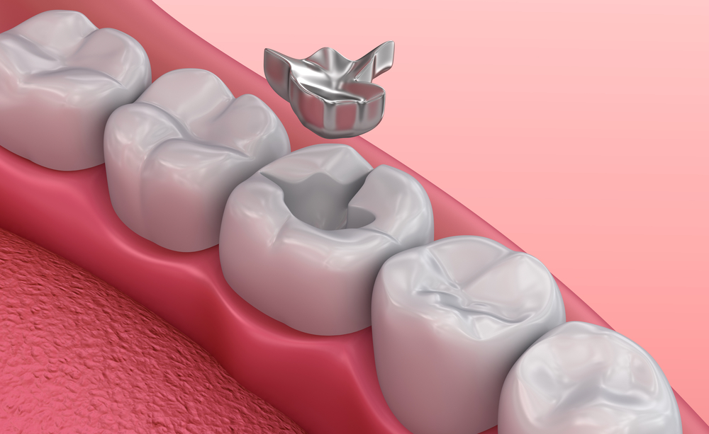 Trám răng thẩm mỹ ở Thái Bình