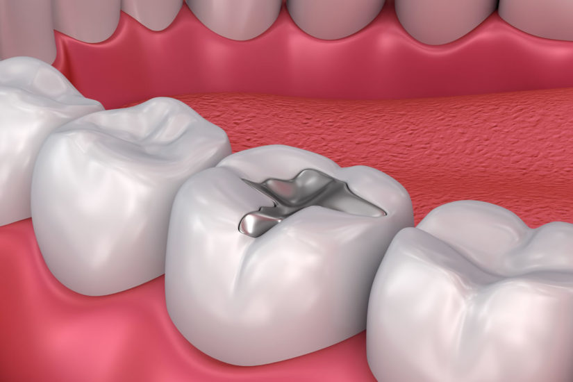 Trám răng thẩm mỹ ở Thái Bình