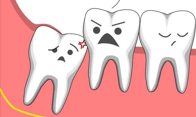 Nhổ răng khôn tại Thái Bình